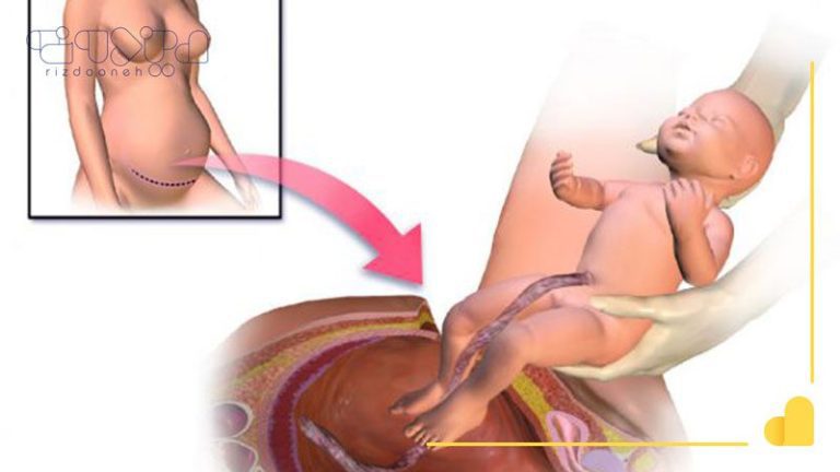 مزایا و معایب زایمان سزارین